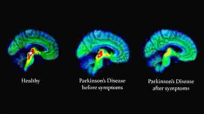 Parkinson's Disease Brain Scan Parkinson S Disease Lars Lundqvist